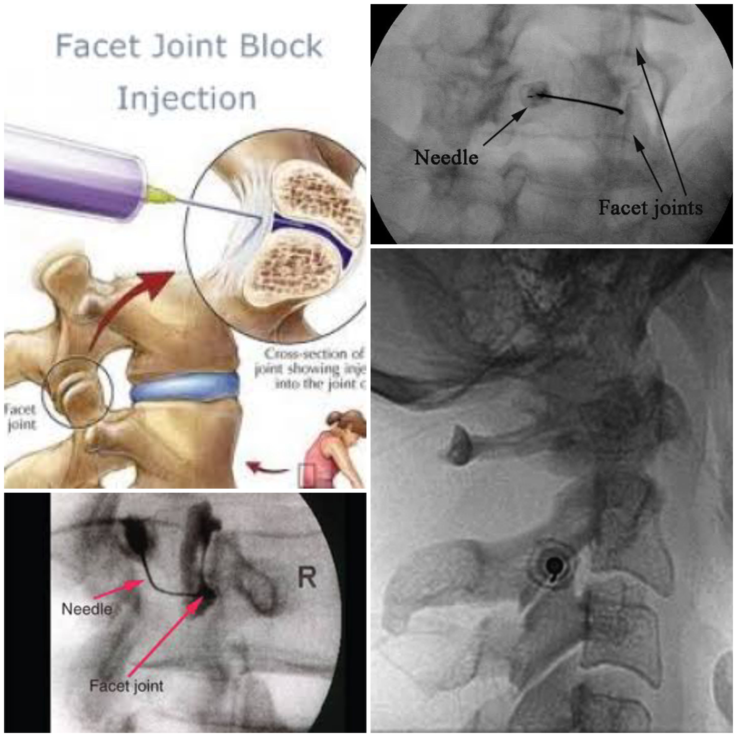 facet joint block injection.jpg